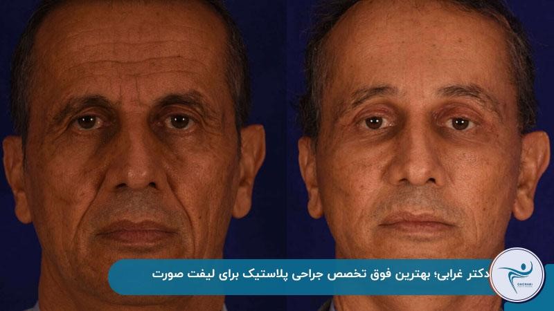 عکس جراحی لیفت صورت