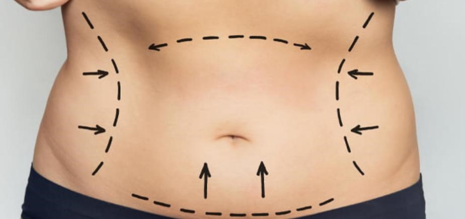 بررسی دلیل‌های مختلف بی‌حسی شکم بعد از ابدومینوپلاستی در مجله دکتر غرابی