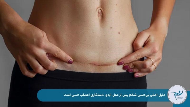 بی حسی شکم بعد از ابدومینوپلاستی به دلیل کشیدگی عصب‌ها