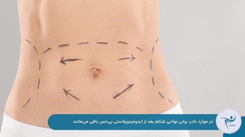 بی‌حسی دائمی شکم بعد از ابدومینوپلاستی در موارد نادر