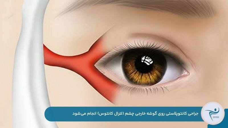 انجام جراحی کانتوپلاستی روی گوشه خارجی چشم