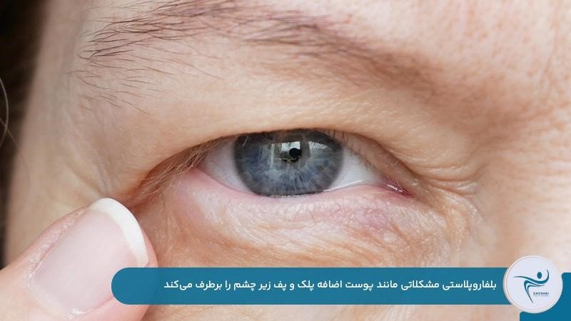 برطرف شدن افتادگی پلک و پف زیر چشم در جراحی بلفاروپلاستی