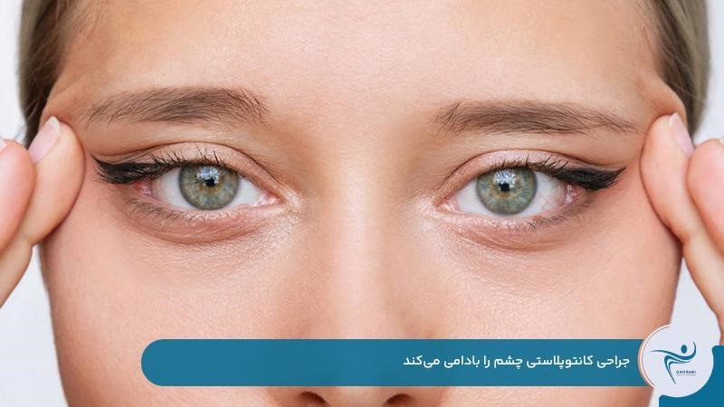 تغییر فرم چشم و بادامی شدن بعد از جراحی کانتوپلاستی