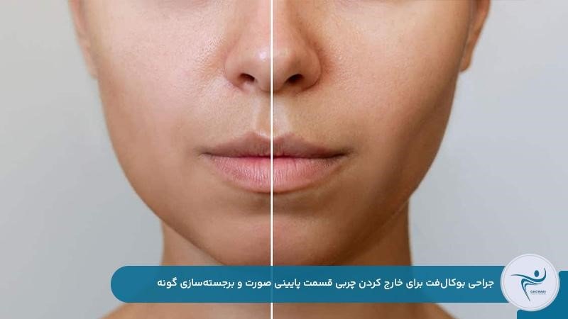 جراحی بوکال‌فت برای برجسته کردن گونه از طریق برداشتن چربی صورت