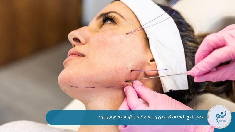 لیفت با نخ برای کشیدن و سفت کردن پوست گونه