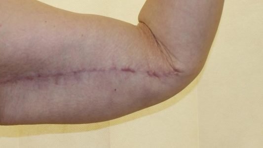 بررسی دلیل ایجاد و روش از بین بردن جای بخیه لیفت بازو در مجله دکتر غرابی