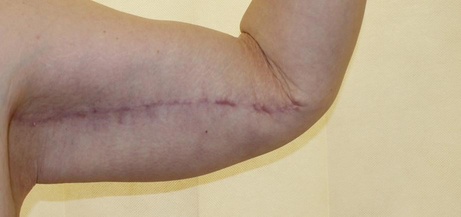 بررسی دلیل ایجاد و روش از بین بردن جای بخیه لیفت بازو در مجله دکتر غرابی