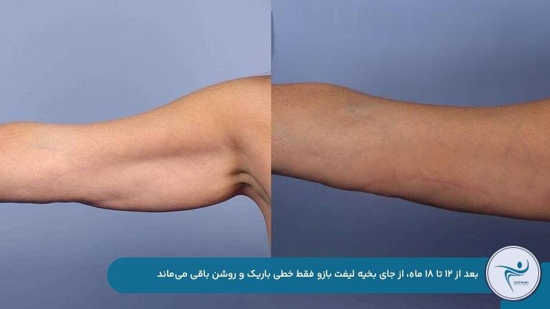 از بین رفتن جای بخیه لیفت بازو بعد از یک سال