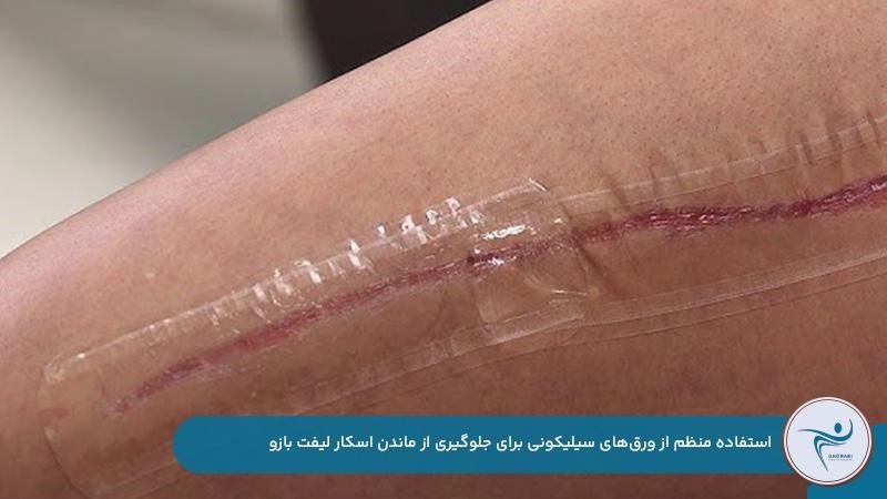 استفاده منظم از ورقهای سیلیکونی برای کمرنگتر شدن جای بخیه لیفت بازو