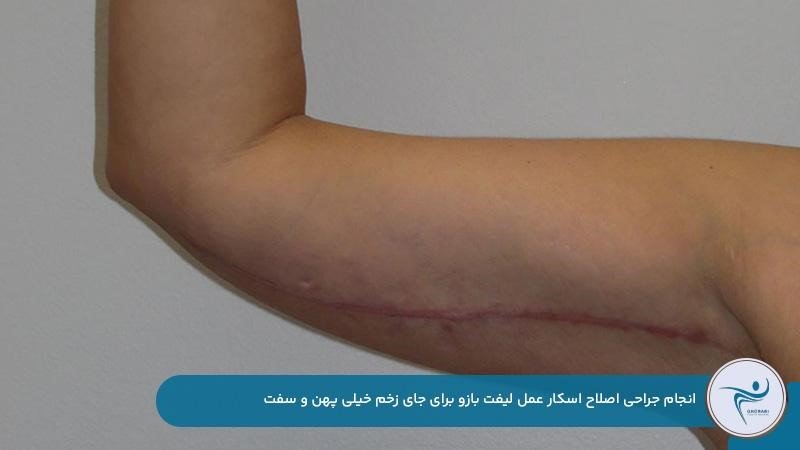 جراحی اسکارهای ضخیم و بدشکل براکیوپلاستی