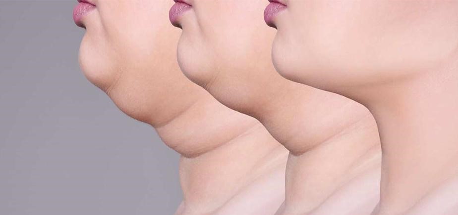 معرفی سریع‌ترین راه رفع غبغب در مجله دکتر غرابی