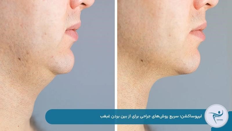 ساکشن بهترین راه رفع غبغب در یک جلسه