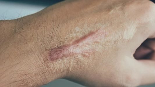  بررسی روش‌های از بین بردن اسکار جراحی در مجله دکتر غرابی