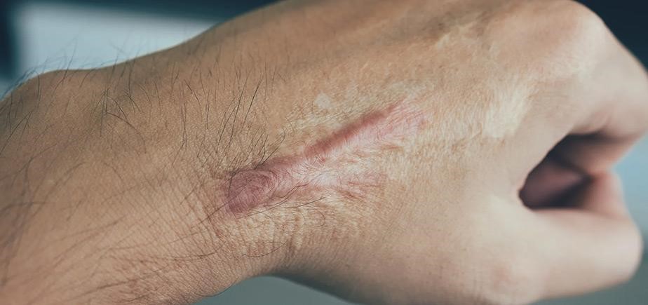  بررسی روش‌های از بین بردن اسکار جراحی در مجله دکتر غرابی