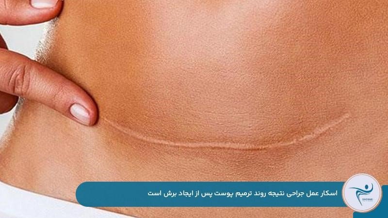 ایجاد اسکار جراحی به‌دلیل روند طبیعی ترمیم زخم