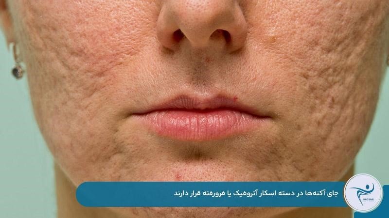 تشکیل اسکار آتروفیک یا فرورفته در صورت 