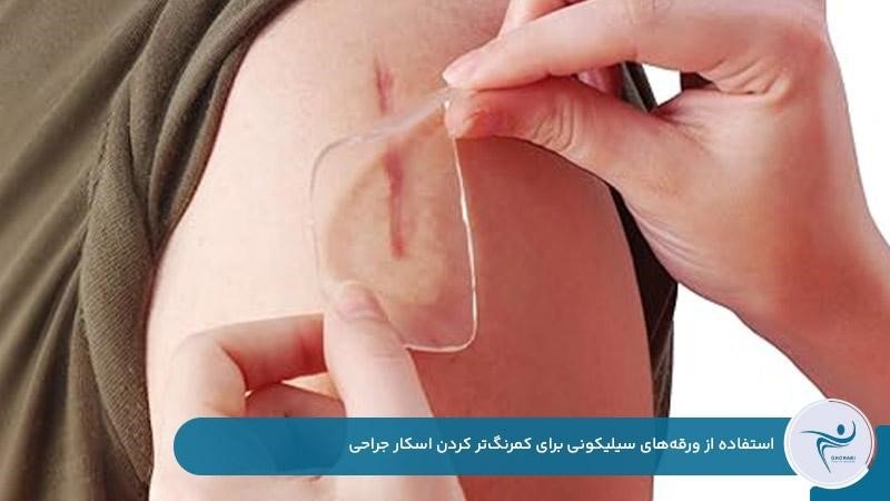 استفاده از ورقه‌های سیلیکونی برای کمرنگ کردن جای اسکار بعد از عمل