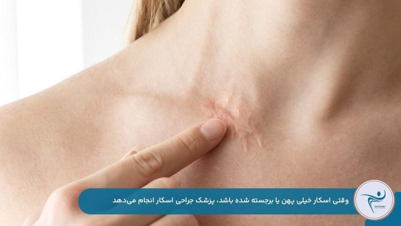 جراحی اصلاح اسکار بعد از عمل درصورت پهن شدن جای زخم