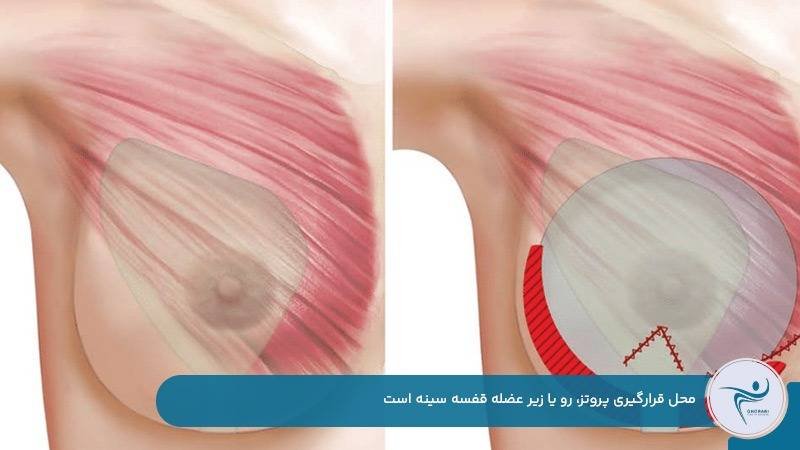 محل قرارگیری انواع پروتز سینه رو یا زیر عضله