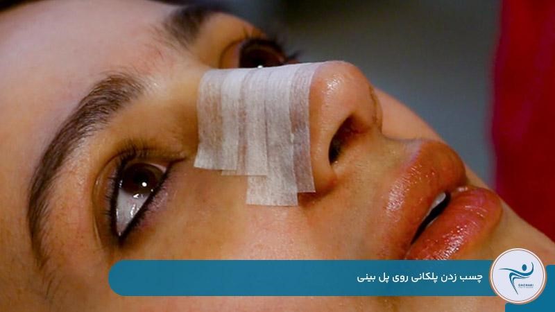 طریقه چسب زدن بینی بعد از عمل بهصورت پلکانی